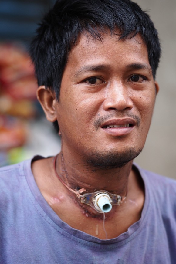 Man With Breathing Tube in His Throat